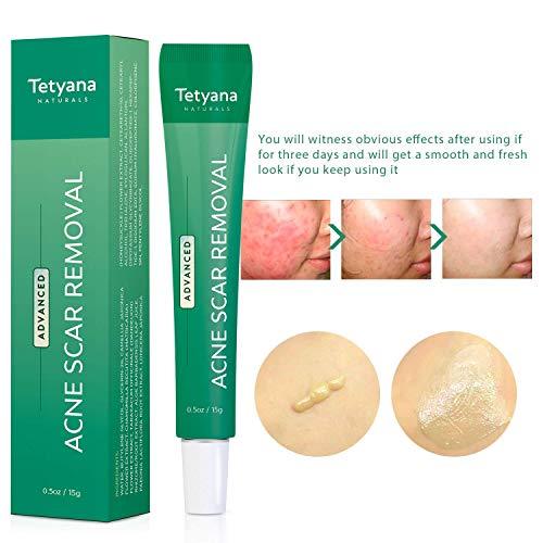 Tetyana naturals Scar Gel, Acne Scar Removal for Face & Body Old & New Scars - 15g